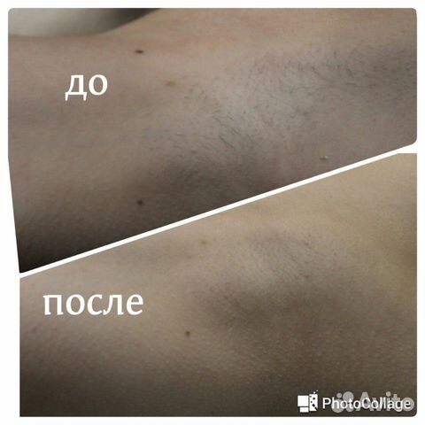 Депиляция шугаринг, воск Депиляция шугаринг, воск