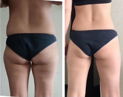 Массаж. Антицеллюлитный массаж. Коррекция фигуры